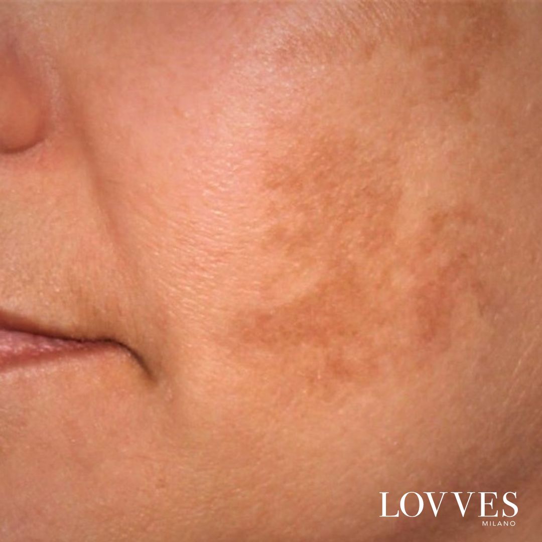 Siero Schiarente Macchie Viso Depigmentante