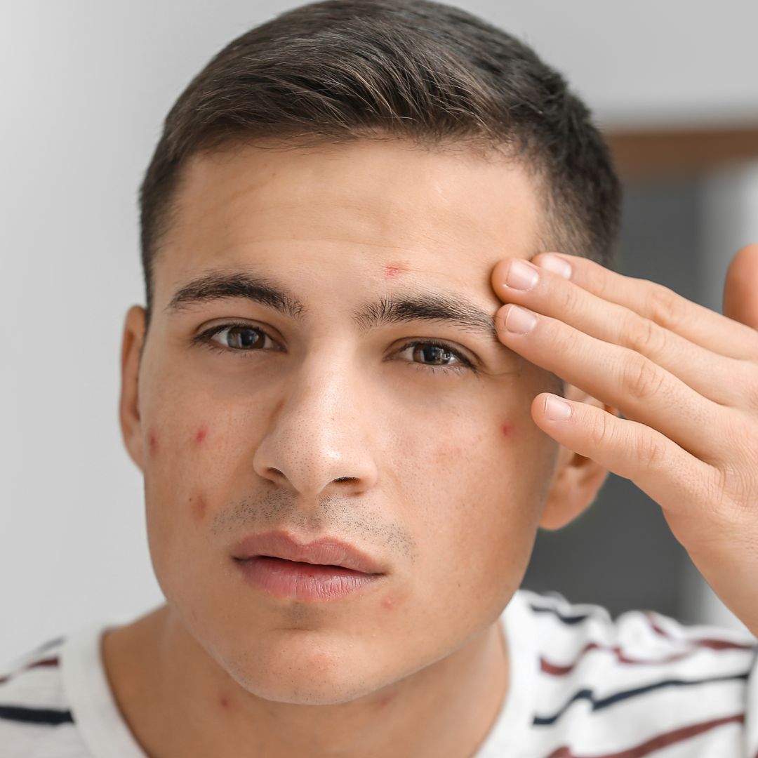 Siero Trattamento Brufoli